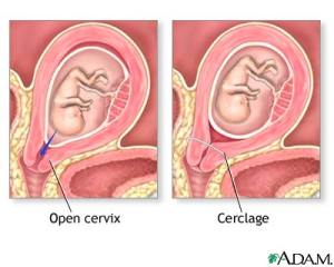 Cerclage