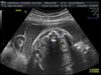 Baby B's Abdomen and Kidneys